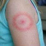 My Daughter Woke Up With a Strange Red Ring on Her Arm: A Parent’s Guide to Ring-Shaped Rashes (And When to Breathe Easy)